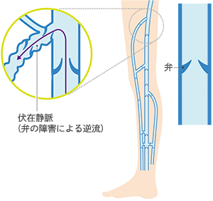 下肢静脈瘤の図解